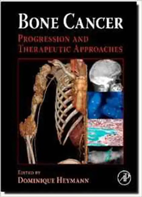 Bone Cancer: Progression and Therapeutic Approaches by Dominique Heymann