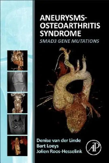 Aneurysms-Osteoarthritis Syndrome: SMAD3 Gene Mutations by Denise Van Der Linde