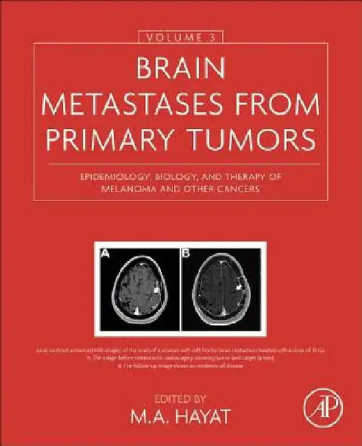 Brain Metastases from Primary Tumors, Epidemiology, Biology, and Therapy of Melanoma and Other Cancers by M. A. Hayat