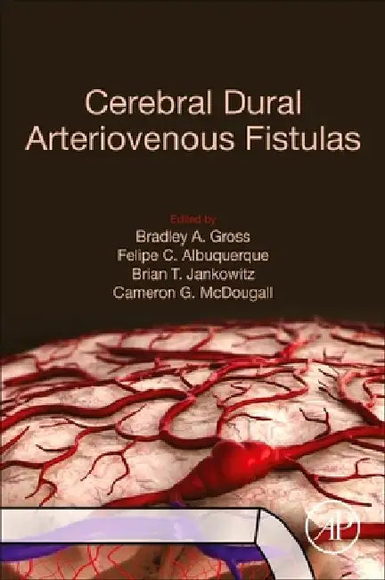 Cerebral Dural Arteriovenous Fistulas by Bradley A. Gross