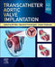 Transcatheter Aortic Valve Implantation by Catherine M. Otto