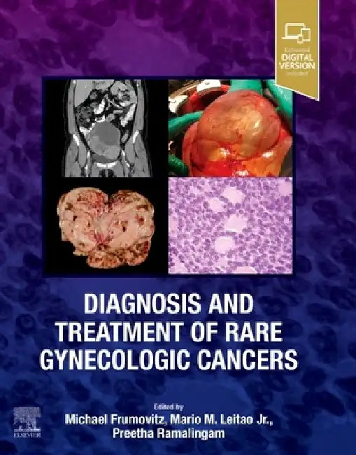 Diagnosis and Treatment of Rare Gynecologic Cancers by Michael Frumovitz