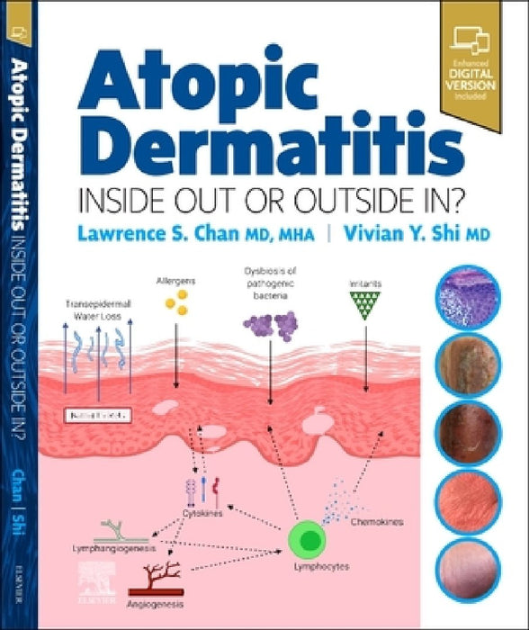 Atopic Dermatitis: Inside Out or Outside in