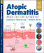 Atopic Dermatitis: Inside Out or Outside in by Lawrence S. Chan