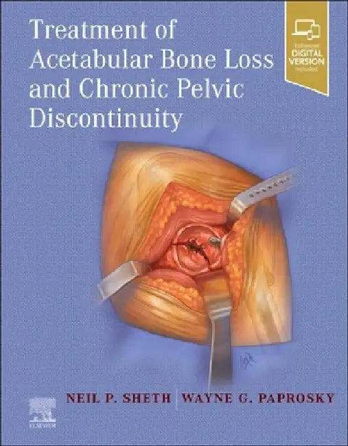 Treatment of Acetabular Bone Loss and Chronic Pelvic Discontinuity by Neil P. Sheth
