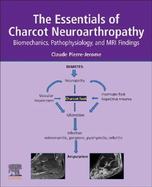 The Essentials of Charcot Neuroarthropathy: Biomechanics, Pathophysiology, and MRI Findings by Claude Pierre-Jerome