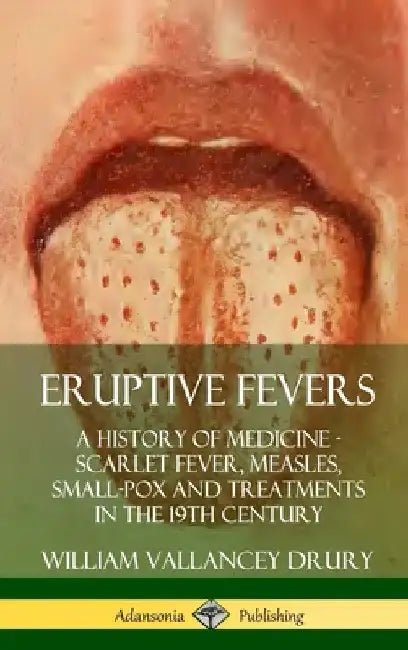 Eruptive Fevers: A History of Medicine - Scarlet Fever, Measles, Small-Pox and Treatments in the 19th Century (Hardcover) by William Vallancey Drury