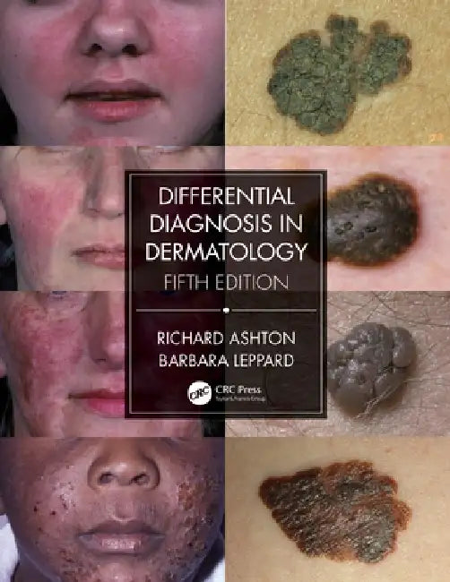 Differential Diagnosis in Dermatology by Richard Ashton