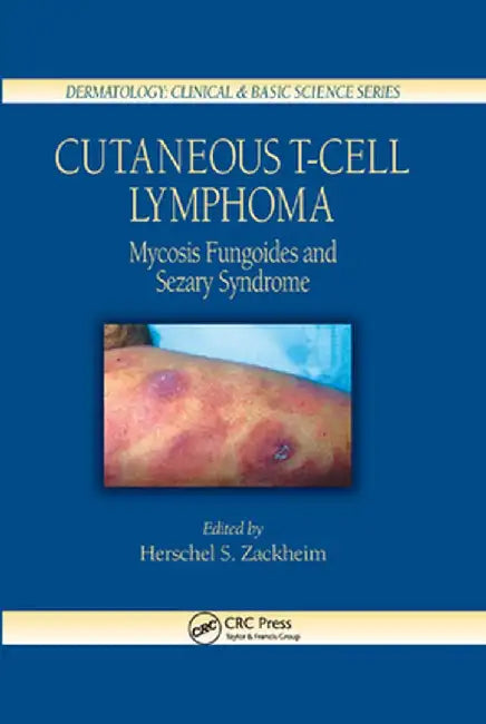 Cutaneous T-Cell Lymphoma: Mycosis Fungoides and Sezary Syndrome by Herschel S. Zackheim
