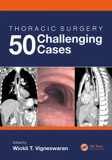 Thoracic Surgery: 50 Challenging Cases by Wickii Vigneswaran