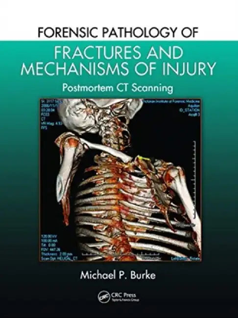 Forensic Pathology of Fractures and Mechanisms of Injury: Postmortem CT Scanning by Michael P. Burke