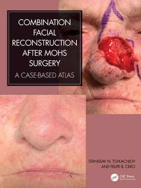 Combination Facial Reconstruction After Mohs Surgery: A Case Based Atlas by Stanislav N. Tolkachjov