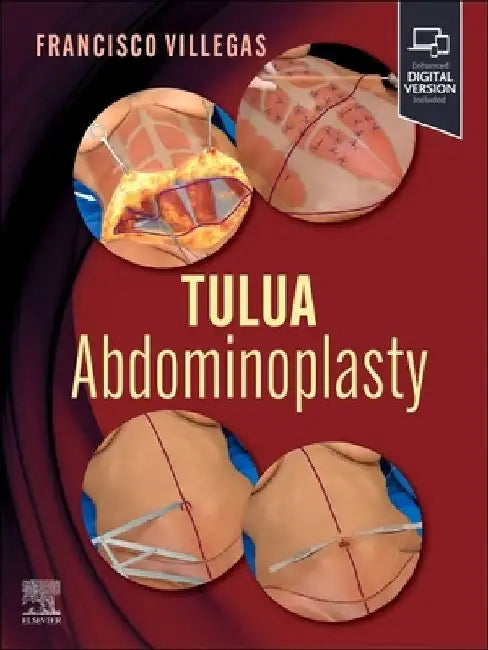 Tulua Abdominoplasty: Transverse Plication Technique by Francisco Javier Villegas-Alza