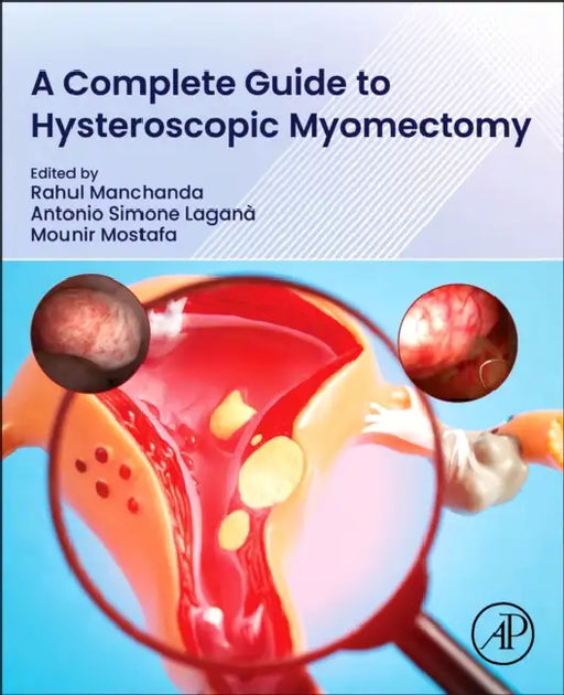 A Complete Guide to Hysteroscopic Myomectomy by Rahul Manchanda