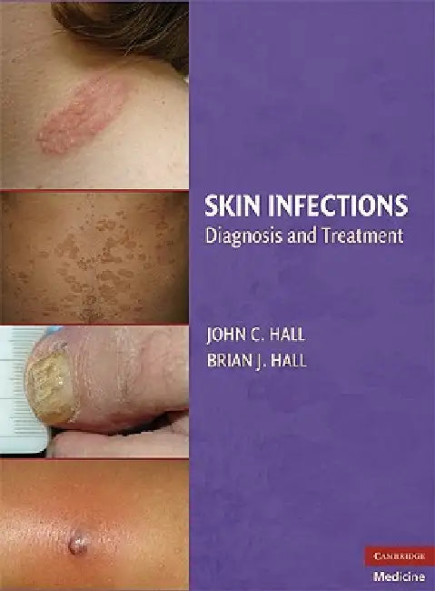 Skin Infections: Diagnosis and Treatment by John C. Hall, Brian J. Hall