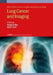 Lung Cancer and Imaging by Ayman El-Baz, Jasjit S. Suri, Ahmed Shaffie