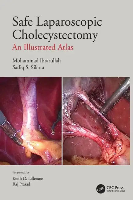 Safe Laparoscopic Cholecystectomy: An Illustrated Atlas by Mohammad Ibrarullah