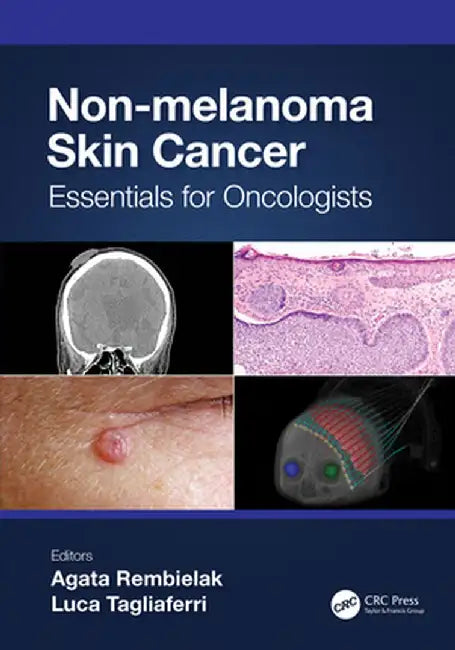Non-Melanoma Skin Cancer: Essentials for Oncologists by Agata Rembielak