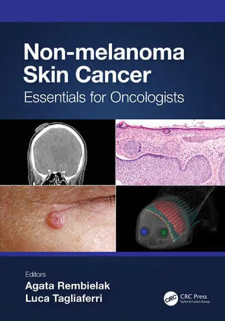 Non-Melanoma Skin Cancer: Essentials for Oncologists by Agata Rembielak