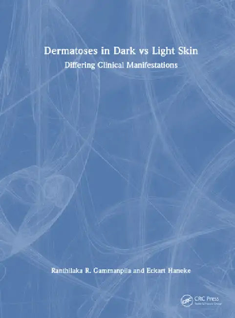 Dermatoses in Dark Vs Light Skin: Differing Clinical Manifestations by Ranthilaka R. Gammanpila
