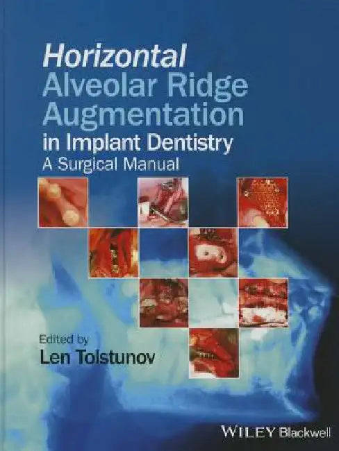 Horizontal Alveolar Ridge Augmentation in Implant Dentistry: A Surgical Manual by Len Tolstunov