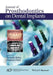 Journal of Prosthodontics on Dental Implants by Avinash Bidra