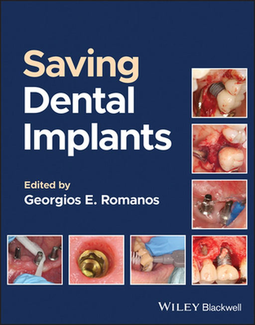 Saving Dental Implants by ROMANOS