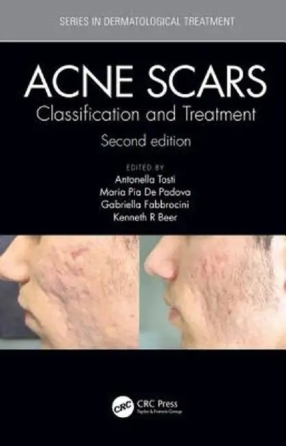 Acne Scars: Classification and Treatment, Second Edition by Antonell Tosti