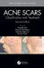 Acne Scars: Classification and Treatment, Second Edition by Antonell Tosti