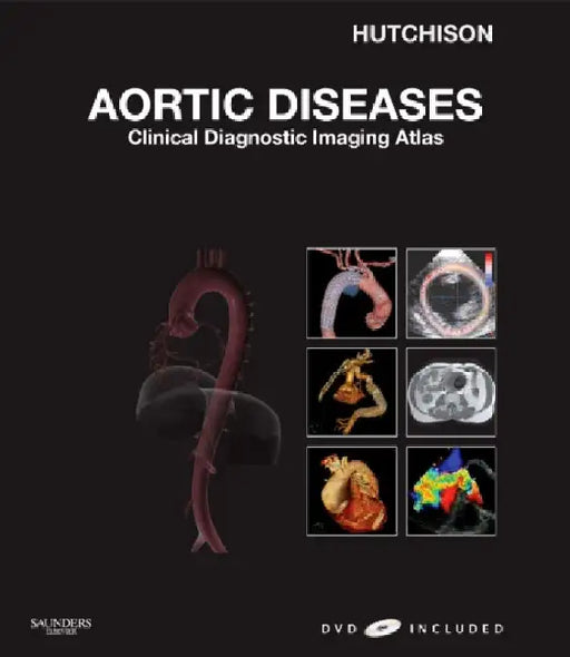 Aortic Diseases by Peter Ashley