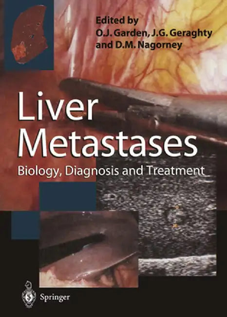 Liver Metastases: Biology, Diagnosis and Treatment by R. A. Audisio