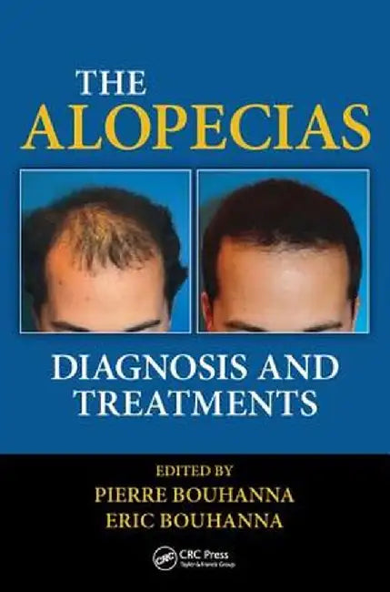 The Alopecias: Diagnosis and Treatments by Pierre Bouhanna