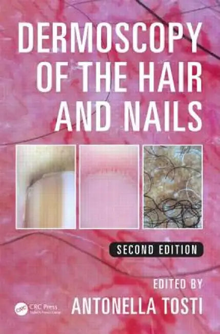 Dermoscopy of the Hair and Nails by Antonella Tosti