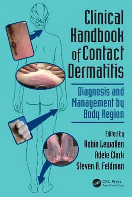 Clinical Handbook of Contact Dermatitis: Diagnosis and Management by Body Region by Robin Lewallen