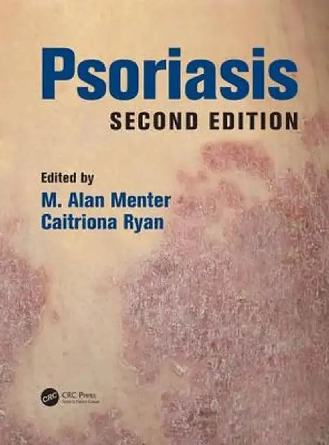 Psoriasis by M. Alan Menter