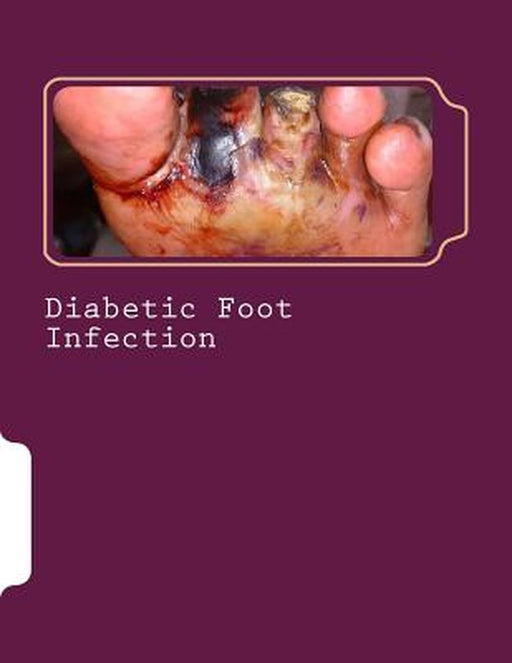 Diabetic Foot Infection by Dr Romana Ayub