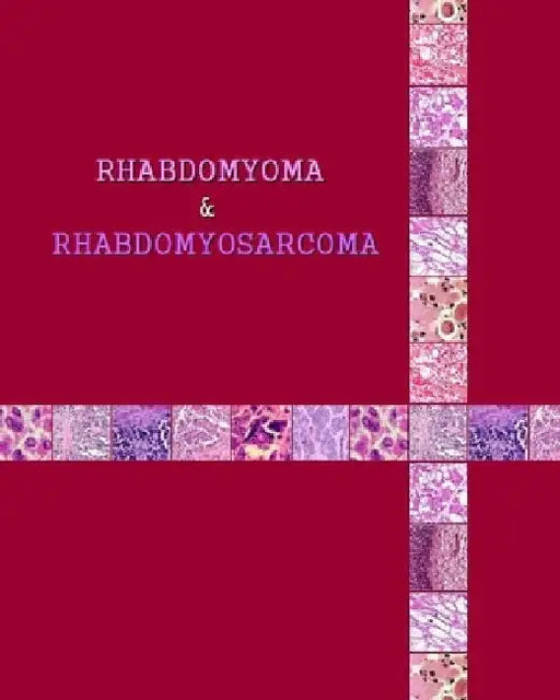 Rhabdomyoma & Rhabdomyosarcoma by Naira Roland Matevosyan