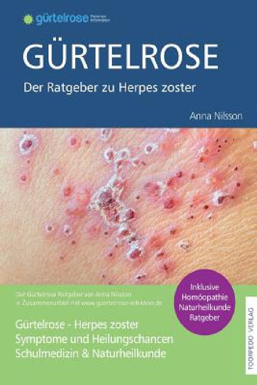 Gürtelrose - Der große Ratgeber zu Herpes zoster: Schulmedizin + Naturheilkunde by Anna Nilsson