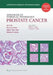 Prostate Cancer by Jae Y. Ro