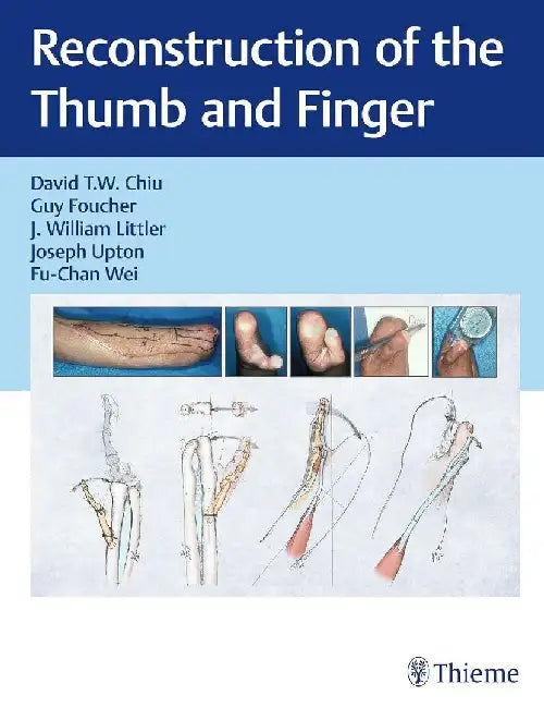 Reconstruction of the Thumb and Finger by David Chiu