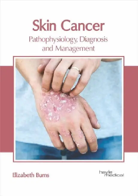 Skin Cancer: Pathophysiology, Diagnosis and Management by Elizabeth Burns