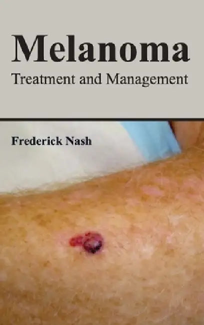 Melanoma: Treatment and Management by Frederick Nash