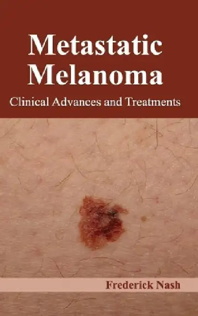Metastatic Melanoma: Clinical Advances and Treatments by Frederick Nash