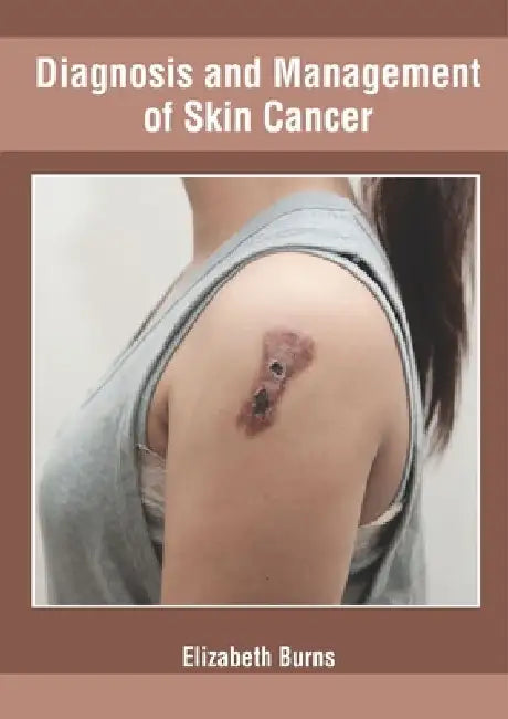 Diagnosis and Management of Skin Cancer by Elizabeth Burns