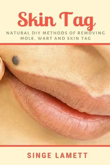 Skin Tag: Natural DIY Methods of removing Mole Wart and Skin Tag by Lamett