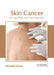 Skin Cancer: Recognition and Management by Elizabeth Burns
