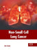 Non-Small Cell Lung Cancer by Jute Cassie