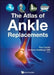 The Atlas of Ankle Replacements by Andrew J. Goldberg Obe
