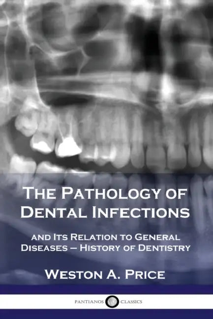 The Pathology of Dental Infections: and Its Relation to General Diseases - History of Dentistry by Weston a. Price