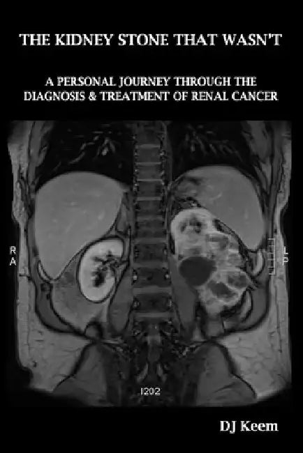 The Kidney Stone That Wasn't: A Personal Journey Through The Diagnosis & Treatment of Renal Cancer by Diane Summerfield